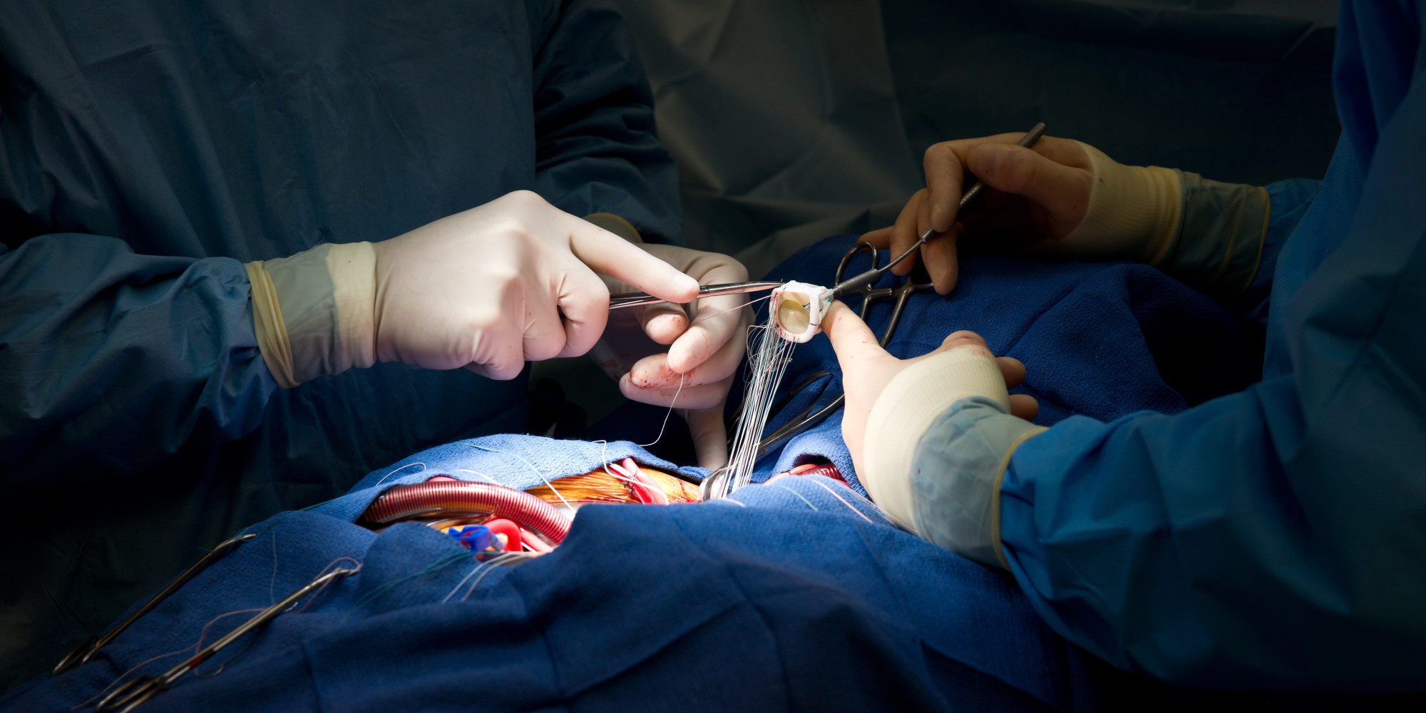 Heart Surgery Aortic Valve Replacement with Xenograft